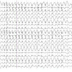 JHACH Spike and Waves